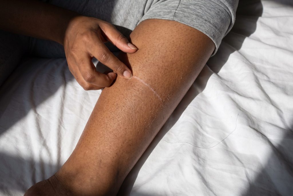 A fingernail leaves a pale, ashy line across the dry skin of a brown shin