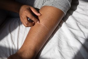 A fingernail leaves a pale, ashy line across the dry skin of a brown shin