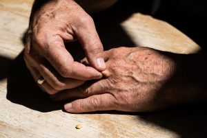 An older man pinches up the thin skin on the back of his hand in hard sunlight
